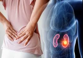 Kidney Stone क्या है ? गुर्द में पथरी के लक्षण, इलाज और कारण