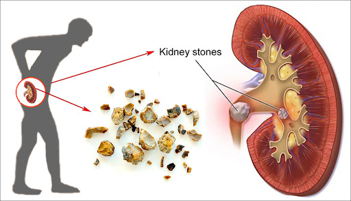 क्या है गुर्दे की पथरी -  What is Kidney Stone in Hindi 
